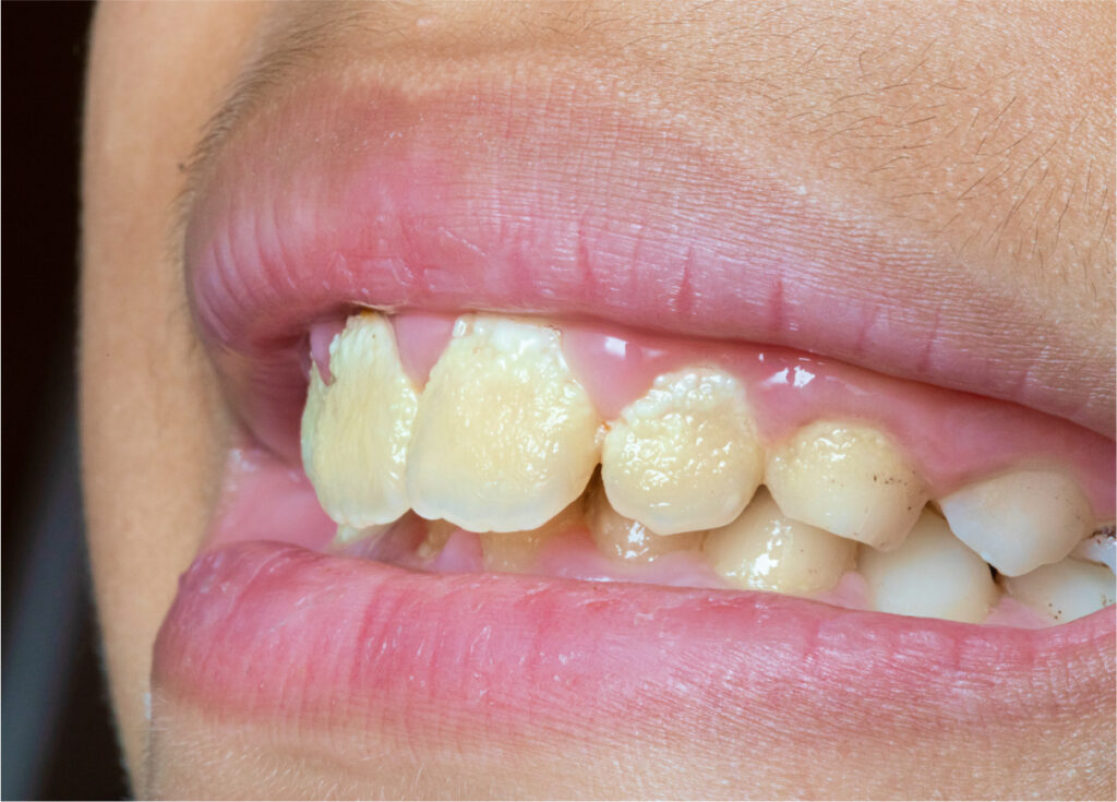 Close-up of teeth showing visible dental cavity and tooth decay