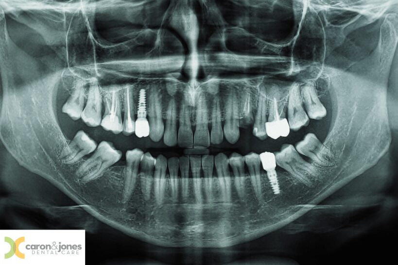 ental X-ray showing jawbone, teeth and dental implant