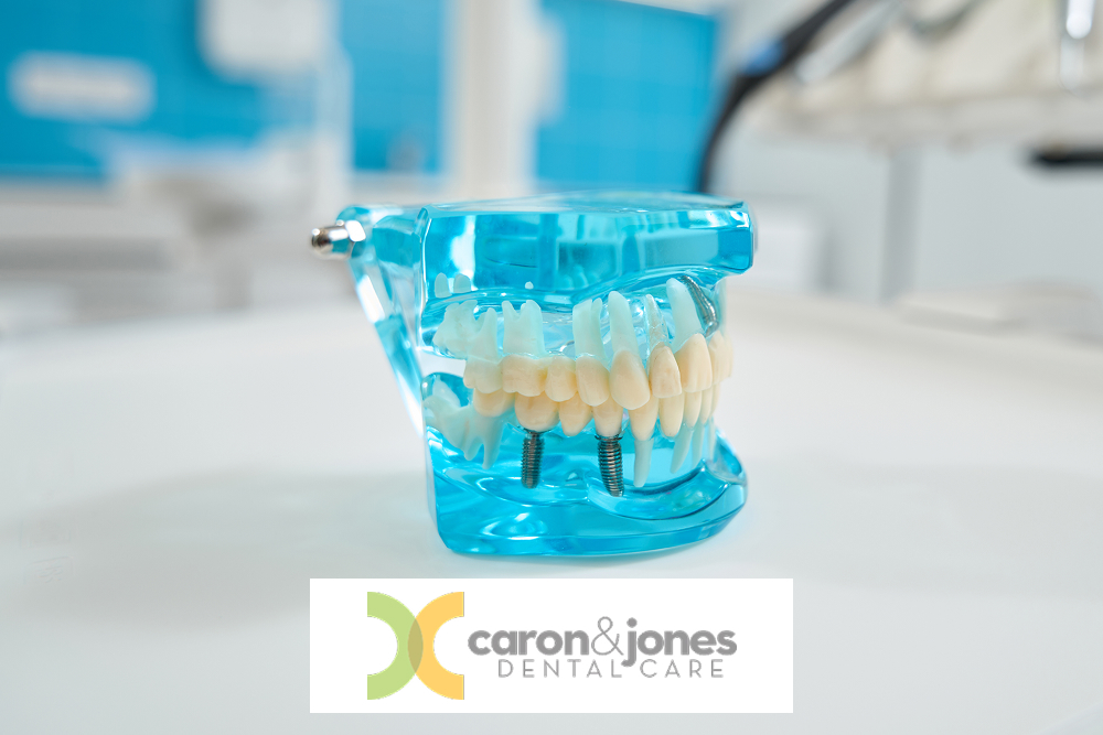 Artificial jaw used by dentists for patient education and medical students