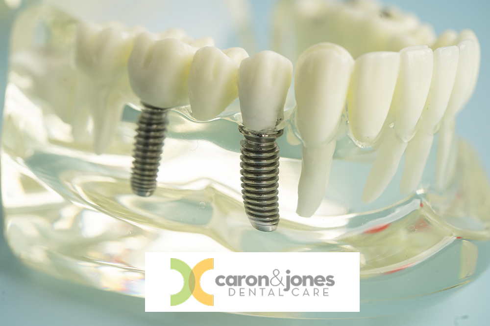 Dental implant, artificial tooth roots into jaw, root canal of dental treatment