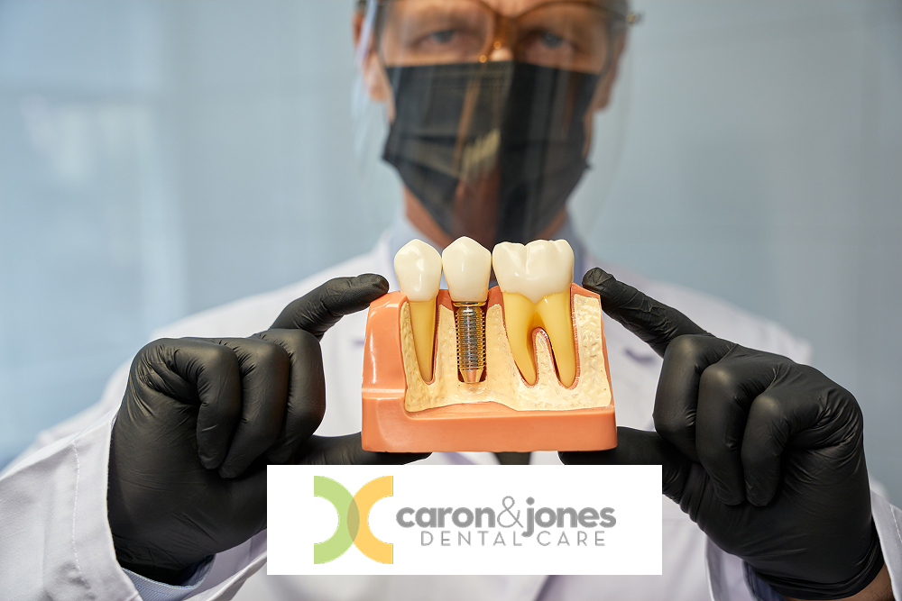 Serious dentist showing a teeth model with implant to camera